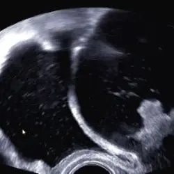 Sonografische Aufnahme, die im Rahmen der Erstuntersuchung bei Verdacht auf eine paravesikale Ovarialzyste erstellt wurde.