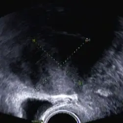 Sonografische Aufnahme, die ein Myom am Uterus zeigt.