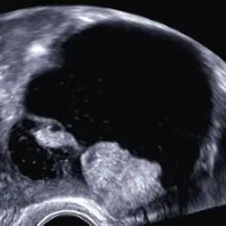 Sonografische Aufnahme, die die rechtsseitig adnexale zystische Raumforderung mit soliden Anteilen in einer weiteren Ansicht zeigt.