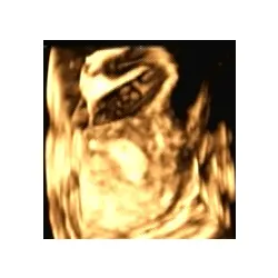 3D-sonografische Aufnahme, die die rechtsseitig adnexale zystische Raumforderung dreidimensional visualisiert.