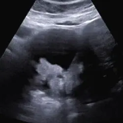 Abdominal-sonografische Aufnahme, die zur Verifizierung des Befundes angefertigt wurde.