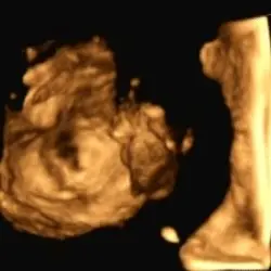 Abdominal-3D-sonografische Aufnahme, die zur Verifizierung des Befundes angefertigt wurde.