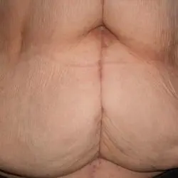 Aufnahme, die die Narbensituation am Abdomen nach multiplen Voroperationen (Sectio caesarea, Cholezystektomie, Teilkolonektomie) dokumentiert.