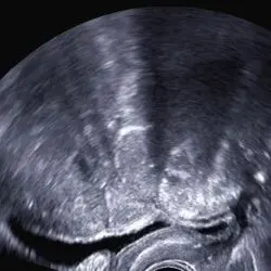 Sonografische Aufnahme, die im Rahmen der postoperativen Kontrolle nach Hysterektomie mit beidseitiger Adnexektomie erstellt wurde.