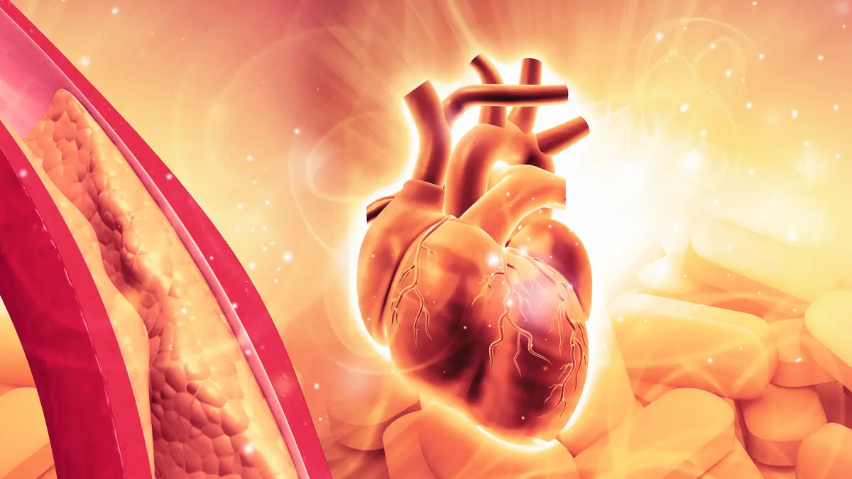 Anatomische Illustration eines menschlichen Herzens mit Arterie und Cholesterin-Ablagerungen