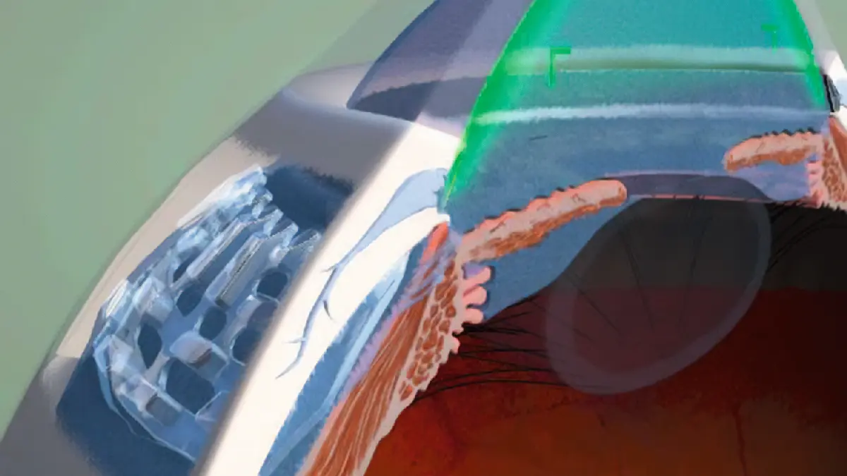 Intercil Uveal Spacer im Ziliarkörper des Auges