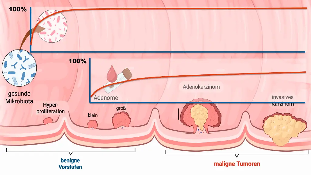 Illustration zur Entstehung von Darmkrebs mit Mikrobiota, Adenomen und Karzinomprogression