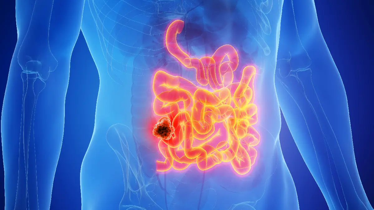 Medizinische 3D-Illustration des Darms mit hervorgehobenem tumorösem Bereich