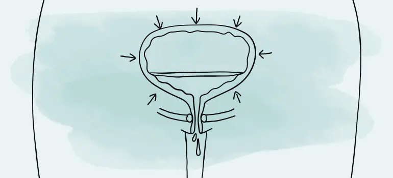 Illustration der Dranginkontinenz – Darstellung eines überaktiven Blasenmuskels mit plötzlichem Harndrang