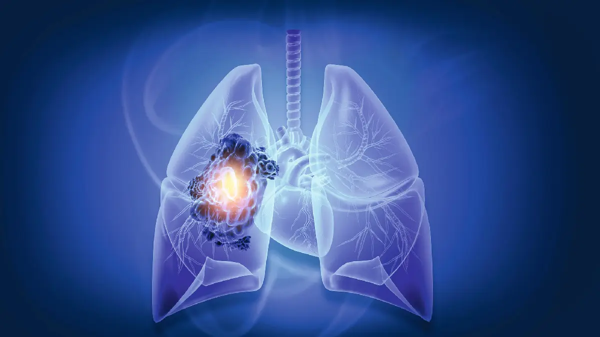 Medizinische Illustration transparenter Lungen mit hervorgehobenem Tumorbereich