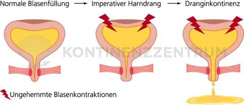 Illustration der Belastungsinkontinenz – Darstellung der Blasenbelastung bei körperlicher Anstrengung