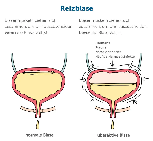 Illustration der Reizblase – Vergleich einer gesunden Blase und einer Reizblase

