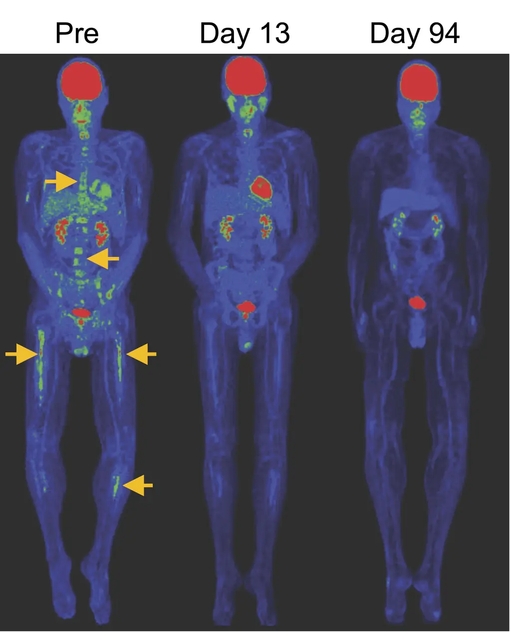 PET/CT-Aufnahmen, die die Rückbildung der Knochenläsionen bei B-Zell-ALL (gelbe Pfeile) nach Infusion von CAR-TSCM-Zellen zeigen.
