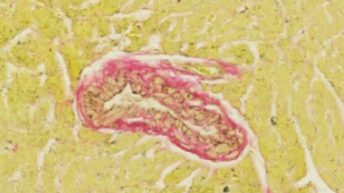 Mikroskopische Gewebeaufnahme eines Blutgefäßes mit sichtbarer Fibrose nach Deaktivierung eines Immun-Checkpoints – Forschungsbild zur Wirkung von Checkpoint-Inhibitoren auf das Herzgewebe