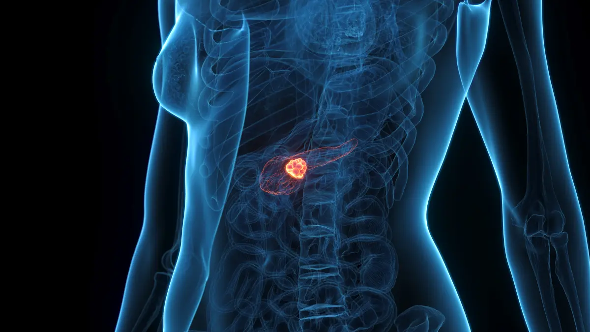 Medizinische 3D-Illustration des Oberkoerpers mit hervorgehobenem Tumor in der Bauchspeicheldruese