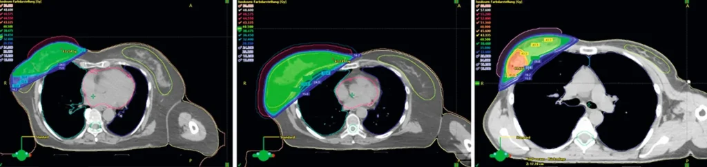 Exemplarische Dosisverteilung bei einer adjuvanten Radiotherapie der Brust: Teilbrustbestrahlung (links), Ganzbrustbestrahlung (Mitte), Ganzbrustbestrahlung mit Boost (rechts).