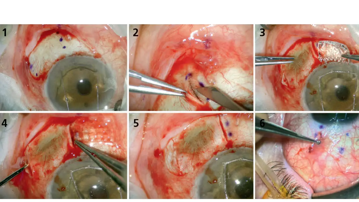 Bilder von Augen-OP Intercil Technologie