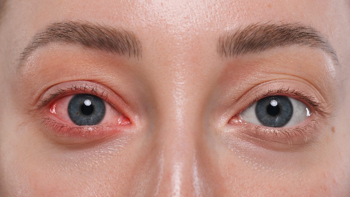 rotes Auge
