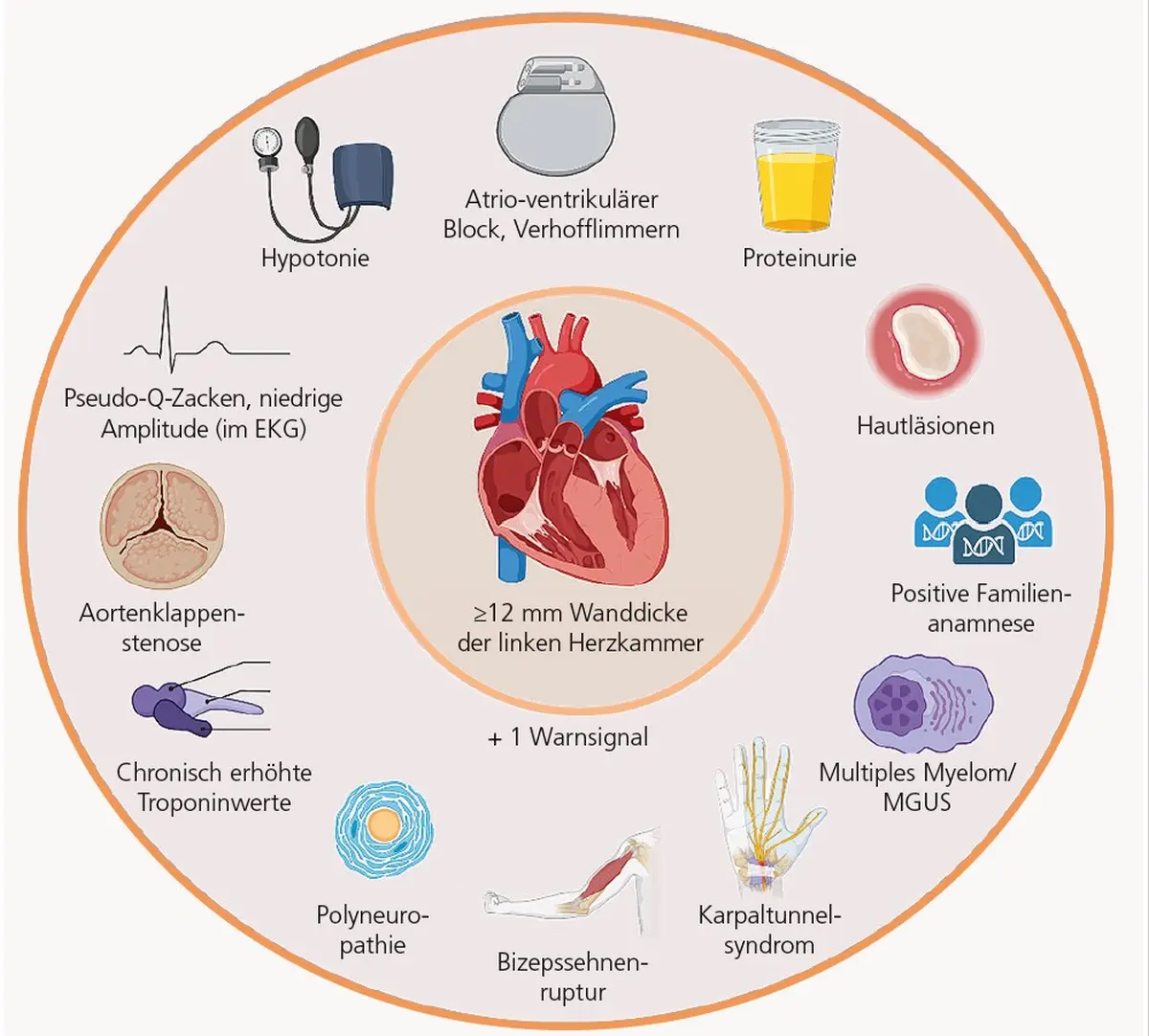 Infografik: Kardiale Red Flags der ATTR-Amyloidose – Warnsignale wie Polyneuropathie, Karpaltunnelsyndrom, erhöhte Troponinwerte und Herzwanddicke ≥12 mm im Überblick