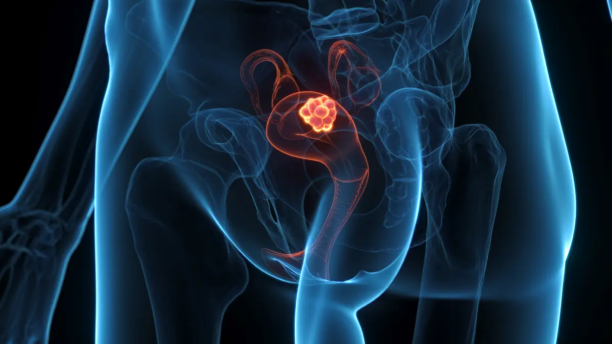 3d illustration eines uterus mit markiertem tumorherd als symbolbild fuer endometriumkarzinom