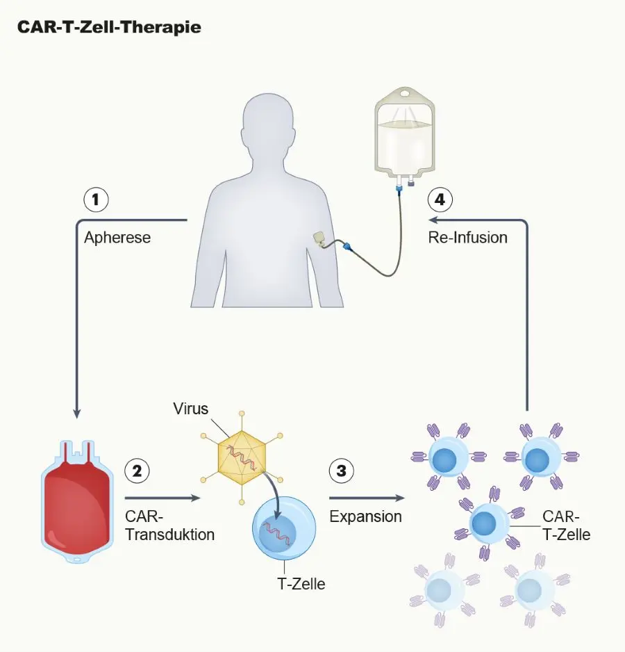 Schematische Darstellung des klassischen Herstellungsprozesses von CAR-T-Zellen: Nach Gewinnung patienteneigener T-Zellen mittels Apherese werden diese im Labor gentechnisch mit einem chimären Antigenrezeptor (CAR) ausgestattet, vermehrt und anschließend dem Patienten reinfundiert. Die Abbildung veranschaulicht das Grundprinzip einer zellulären Immuntherapie, die auch für Hauttumoren zunehmend an Bedeutung gewinnt. Abbildung modifiziert nach (1); ©Hermann UKW