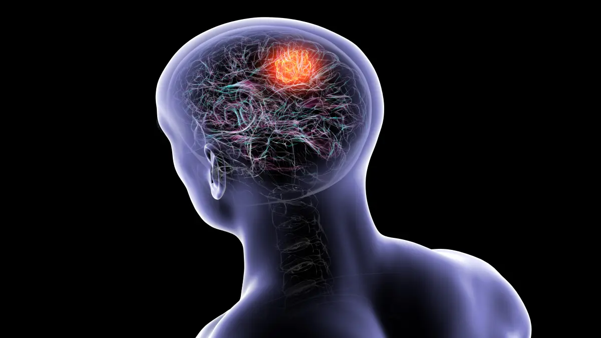 3d illustration eines hirntumors im menschlichen gehirn mit leuchtendem tumorherd