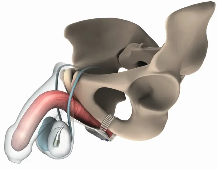 Abb. 1: ATOMS (Adjustable Transobturator Male System, AMI, Österreich)