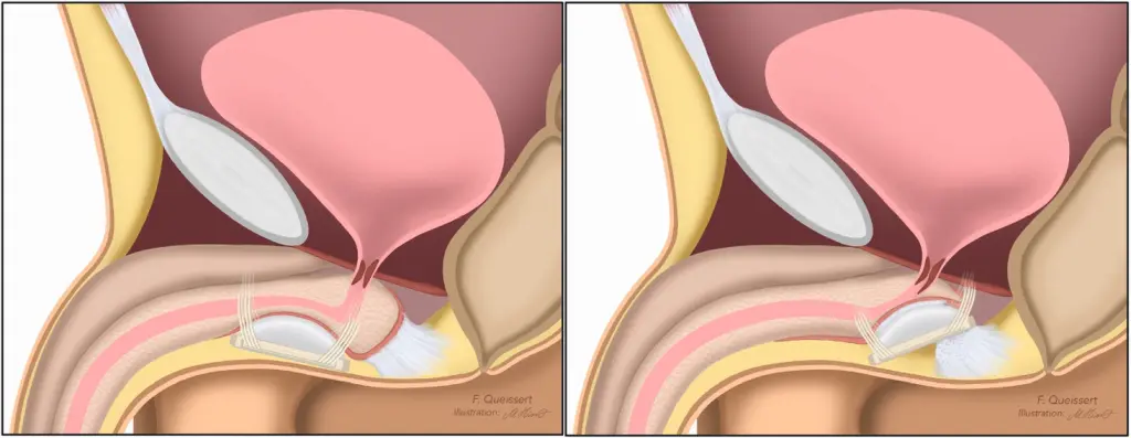 Abb. 2: links: ATOMS Standard Implantation, rechts: ATOMS mit proximaler Implantation, gut sichtbar wird der urethrale Bulbus und teilweise der urethrale Sphinkter direkt unterstützt.