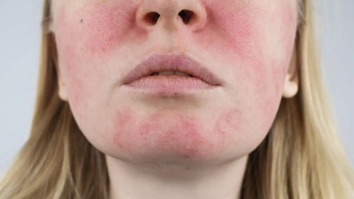 Person mit ausgepraegter Roete und Entzuendung im Gesicht als Beispiel dafuer, wo medizinische Notwendigkeit auf aesthetische Praezision trifft