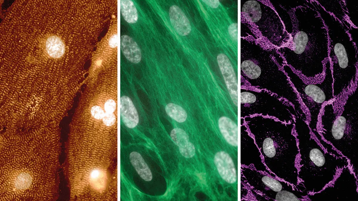 Fluoreszenzmikroskopie: Kardiomyozyten (orange), kardiale Fibroblasten (grün) und Endothelzellen (magenta) aus patientenspezifischen Stammzellen, Noonan-Syndrom-Forschung, UMG Göttingen