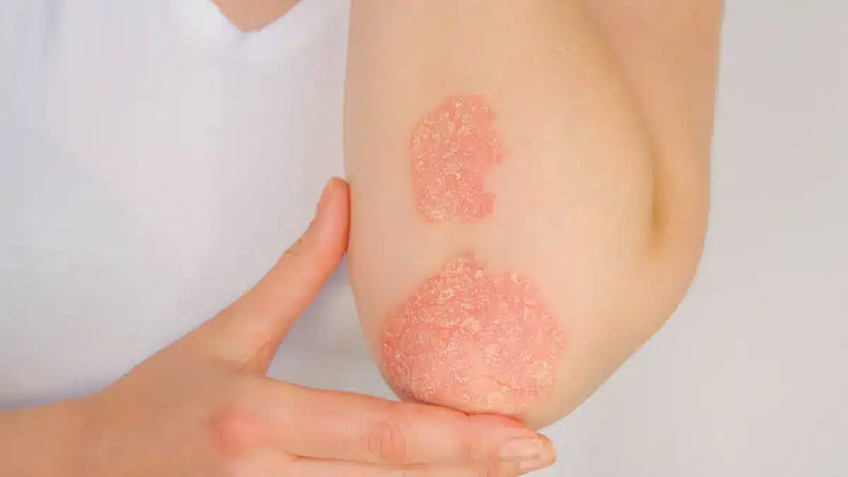 Nahaufnahme von Psoriasis Plaques am Ellbogen einer Person als Symbol fuer die Rolle von PA2G4 bei Psoriasis