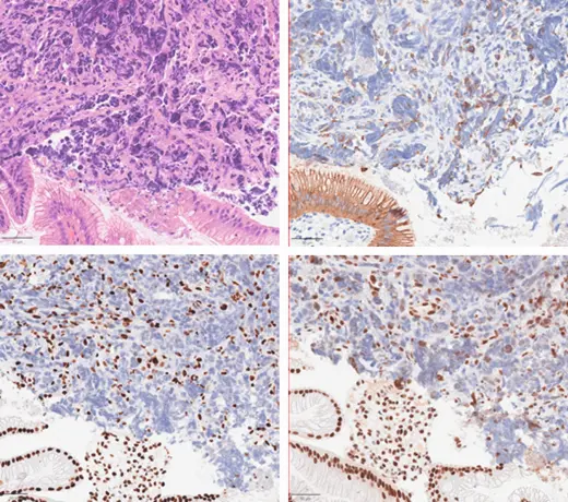  oben: HE-Standardfärbung und rechts Immunhistochemie AE1/AE3 mit ­positiver Expression in den Tumorzellen, unten: SMARCA2 und SMARCA4 jeweils mit Expressionsverlust in den Tumorzellkernen (bei guter interner Positivkontrolle in den Kerner der normalen Schleimhaut und Stromazellen).