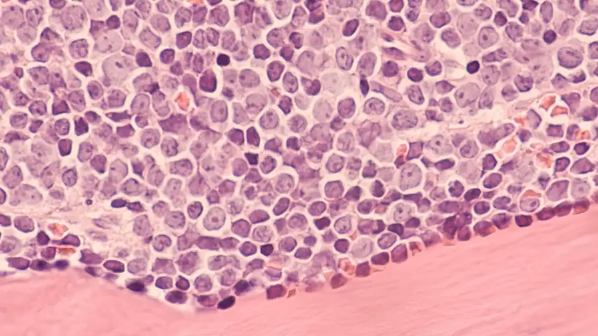 tafasitamab hochrisiko dlbcl histologische mikroskopaufnahme eines aggressiven b zell lymphoms