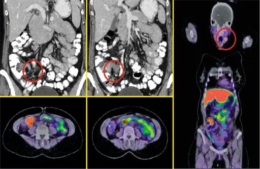 CT und Ga68-PETCT mit neuroendokrinem Tumor im Ileum und weiteren Somatostatin-Rezeptor-positiven Laesionen