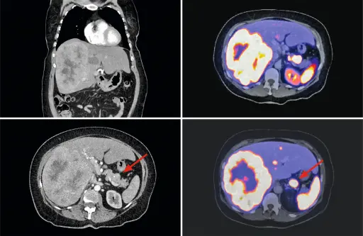 CT und Ga68-PETCT des Abdomens mit neuroendokrinem Tumor im Pankreas und Somatostatin-Rezeptor-positiven Lebermetastasen
